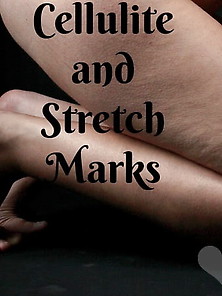 Cellulite And Stretch Marks,  Scars And Wobbly Bits