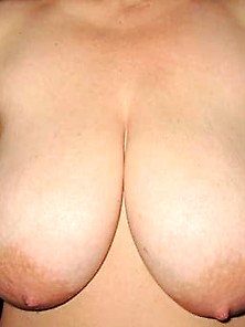 Saggy Tits-Breast Reduction 040