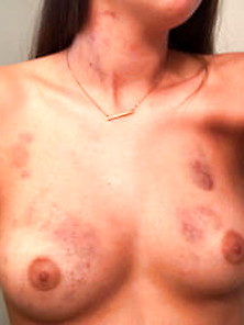 Hailey Danko Bruised Titties